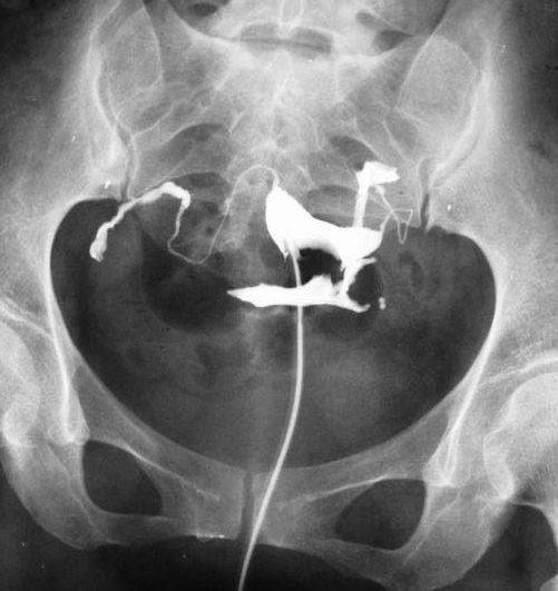 子宮輸卵管造影