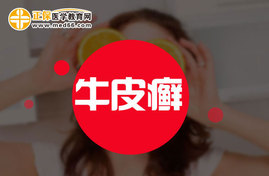 普通不太嚴(yán)重的牛皮癬能治好嗎？