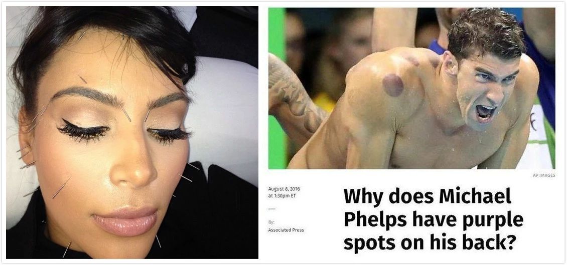 川普正式簽署針灸將納入美國醫(yī)保打臉中醫(yī)黑，美針灸師人數(shù)超過大中國！