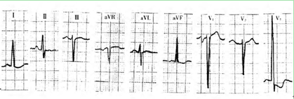 5心電圖 5心電圖