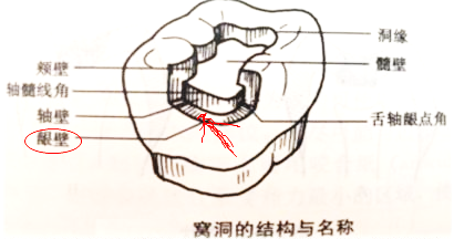 窩洞的結(jié)構(gòu)和名稱 窩洞的結(jié)構(gòu)和名稱