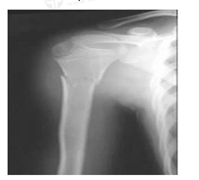 男，45歲，摔傷40分鐘，診斷為