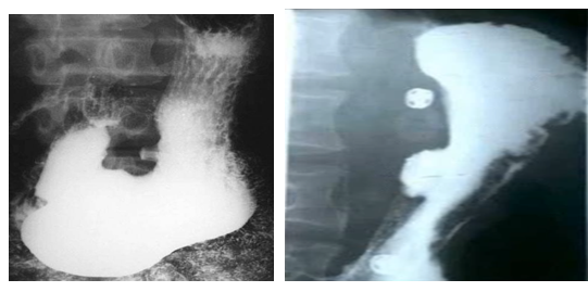 男性，55歲，上腹隱痛約十年，請做出正確診斷