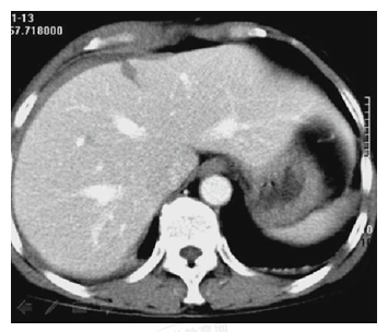 患者，女性，20歲。胸腹部被車撞傷5小時(shí)。診斷為