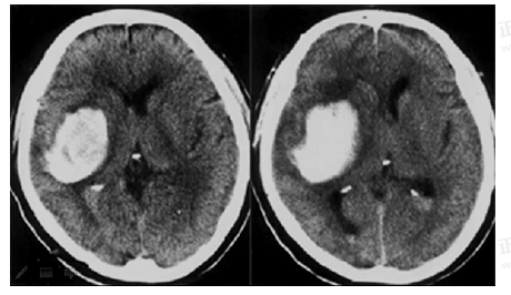 男55歲，左側(cè)肢體偏癱4小時(shí)，有高血壓史，診斷為