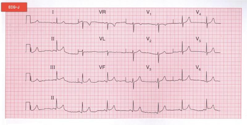 心動過緩 心動過緩