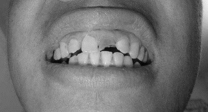 病例分析1 病例分析1