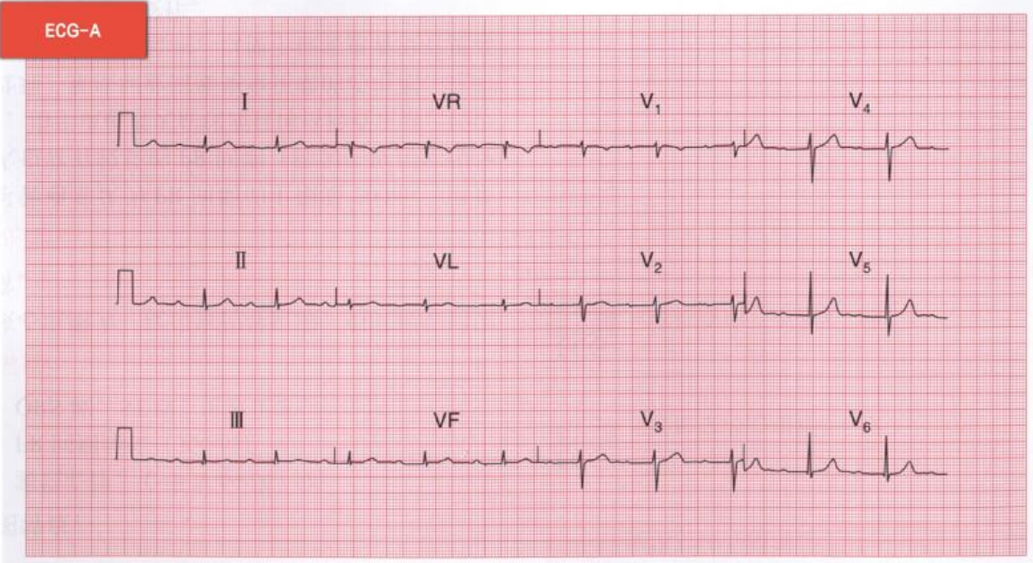 01卷-6.【ECG-A】此心電圖診斷為 01卷-6.【ECG-A】此心電圖診斷為