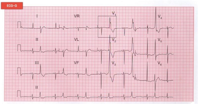 心電圖診斷 心電圖診斷