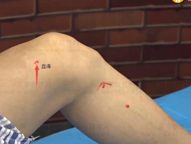 血海 血海