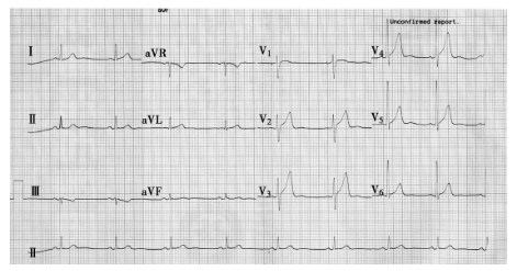竇性心動過緩 竇性心動過緩