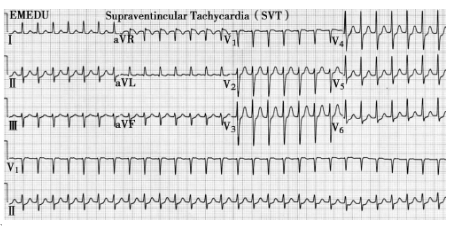 陣發(fā)性室上性心動過速 陣發(fā)性室上性心動過速