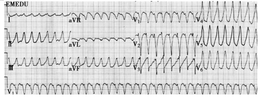 室性心動過速 室性心動過速