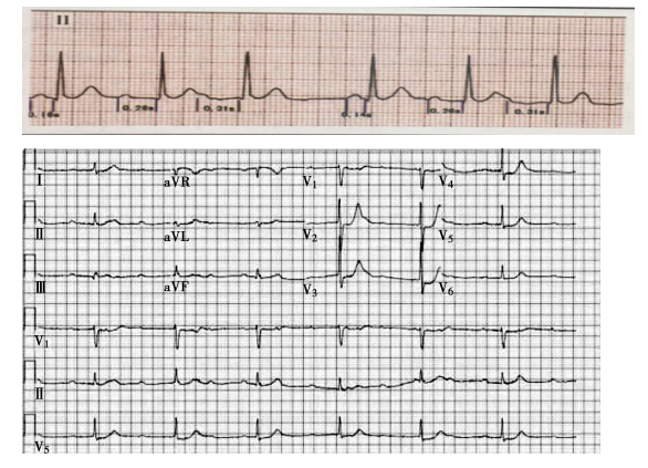 完全性房室傳導阻滯 完全性房室傳導阻滯