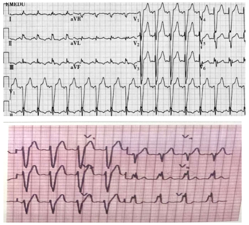 完全左束支傳導阻滯 完全左束支傳導阻滯