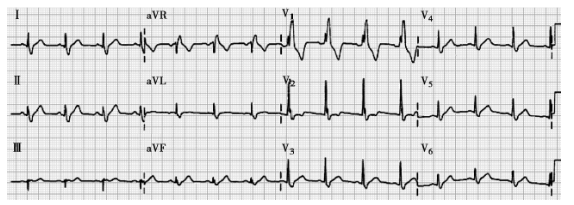 完全右束支傳導阻滯 完全右束支傳導阻滯