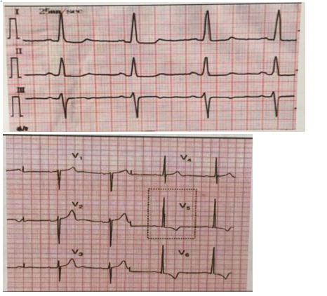 左心室肥厚 左心室肥厚