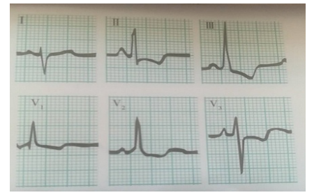 右心室肥大 右心室肥大