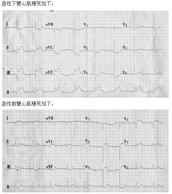 急性心肌梗死 急性心肌梗死