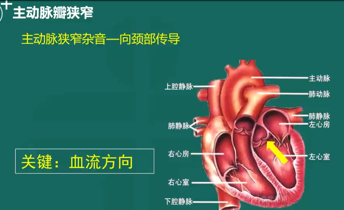 主動脈瓣狹窄-5 主動脈瓣狹窄-5