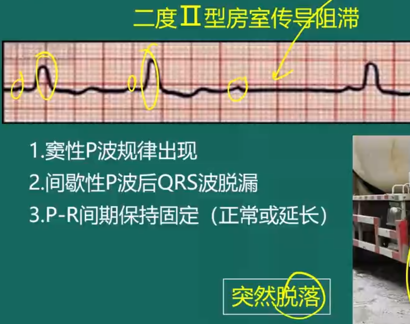 房室傳導(dǎo)阻滯-3 房室傳導(dǎo)阻滯-3