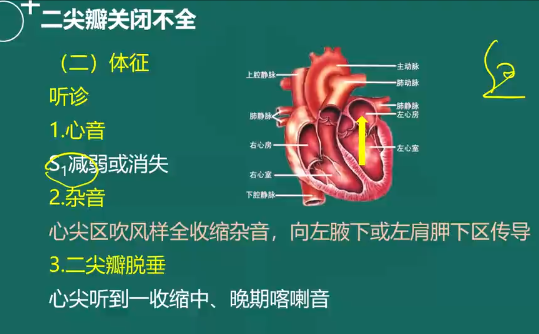 二尖瓣關(guān)閉不全-4 二尖瓣關(guān)閉不全-4