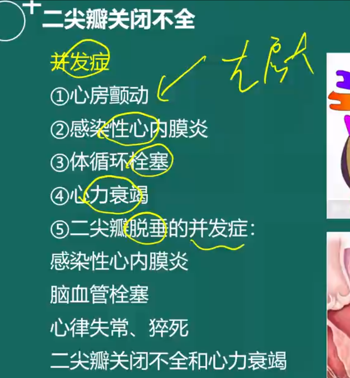 二尖瓣關(guān)閉不全-5 二尖瓣關(guān)閉不全-5