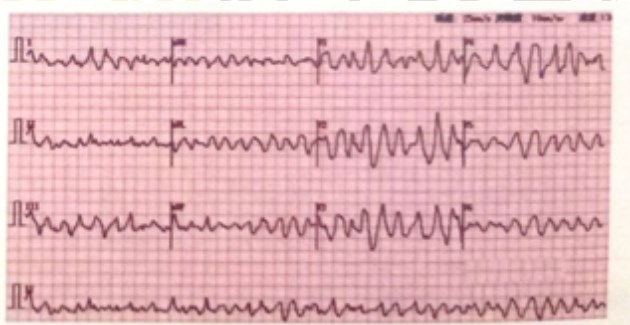 心電圖練習題2 心電圖練習題2
