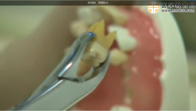 體格檢查考查項(xiàng)目2-牙拔除術(shù)(上頜第一磨牙) 體格檢查考查項(xiàng)目2-牙拔除術(shù)(上頜第一磨牙)