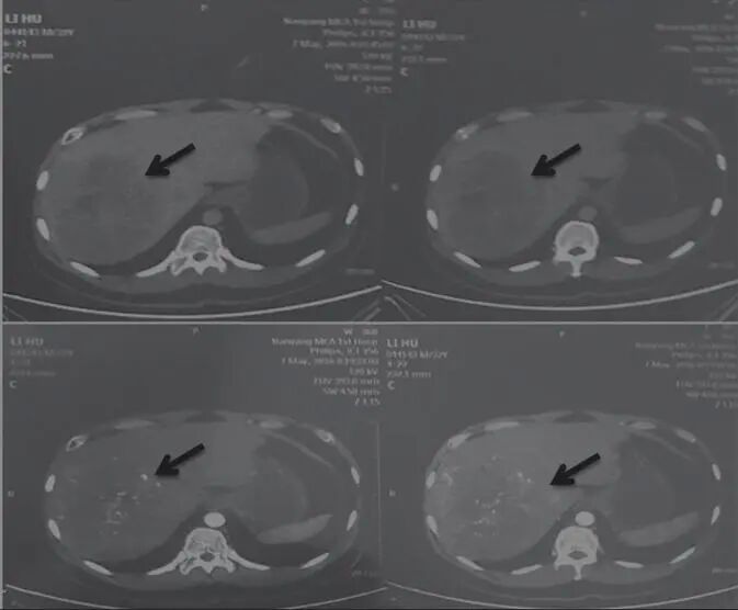 圖1 舒達(dá)少陽(yáng)防治腫瘤驗(yàn)案初診CT結(jié)果
