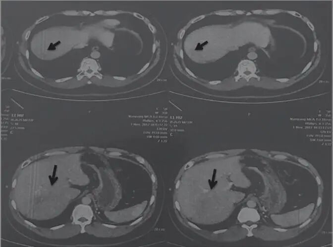 圖2 舒達(dá)少陽(yáng)防治腫瘤驗(yàn)案2017年11月1日CT結(jié)果