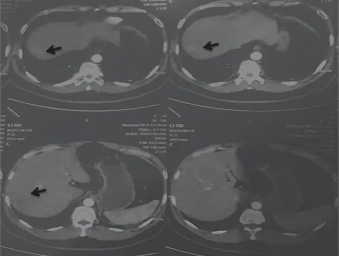 圖3 舒達(dá)少陽(yáng)防治腫瘤驗(yàn)案2018年3月30日CT結(jié)果